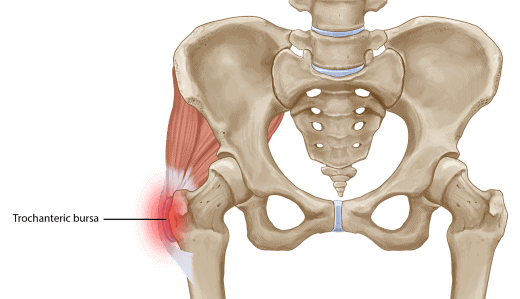 Tegning af slimsækbetændelse på hoften der giver smerter på ydersiden af hoften